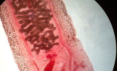 Anvilostomosis in humans