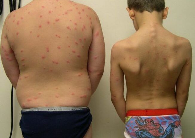 Skin rashes with worms