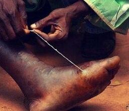 Parasite at the foot of a person